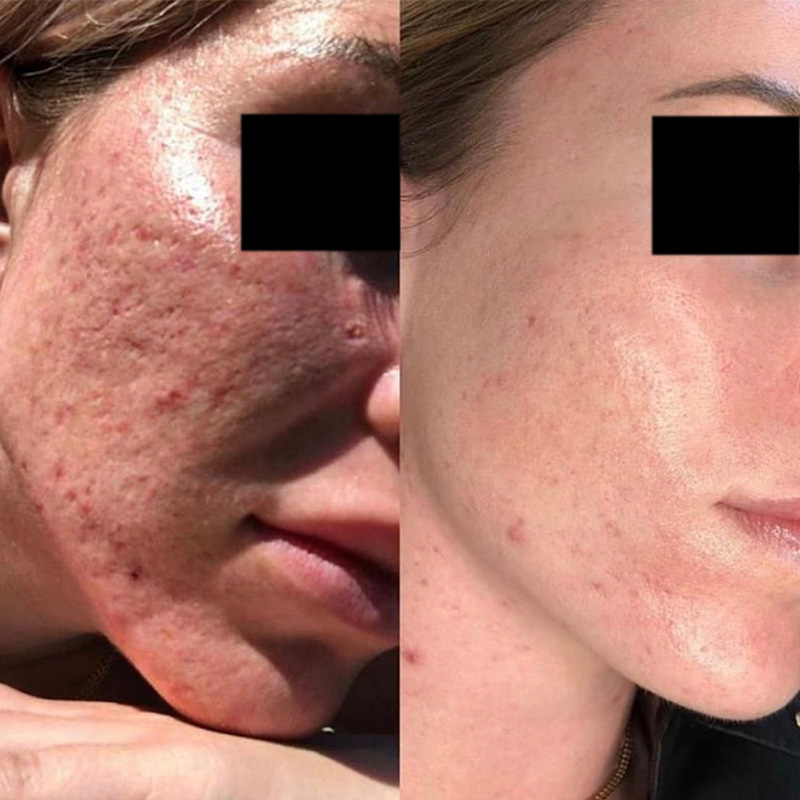 Venus Viva Acne Before and After
