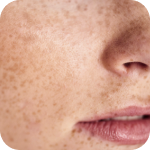 Hyperpigmentation