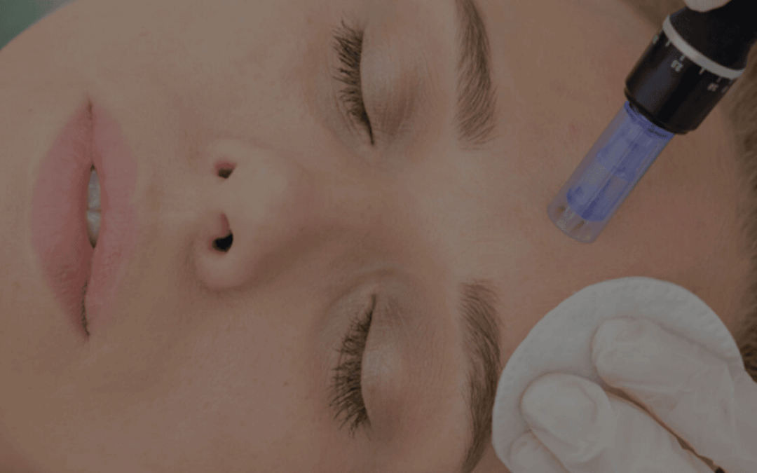 Skin Needling in Australia: How does it work?