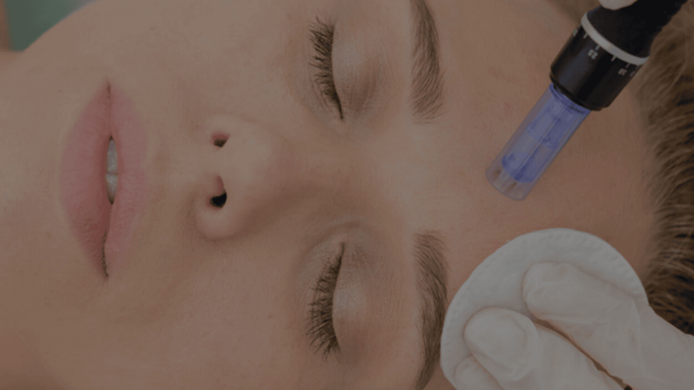 Skin Needling in Australia