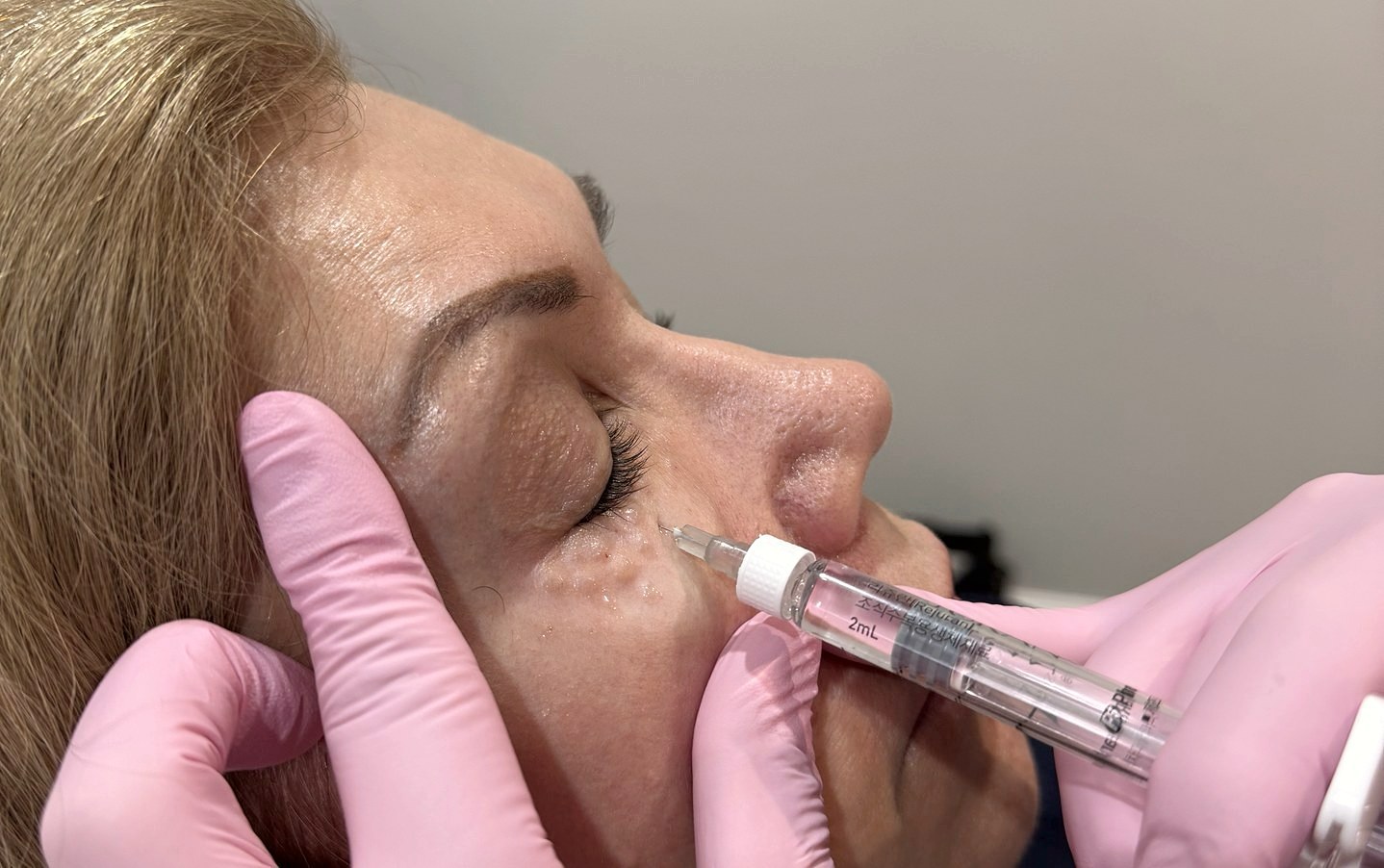Rejuran (salmon DNA) treatment being performed under the eye at Diamond Aesthetics Parramatta
